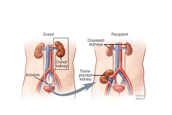 Renal Transplant